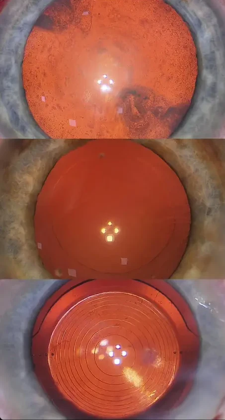 Cirurgia de Catarata - Procedimento realizado com equipamento moderno