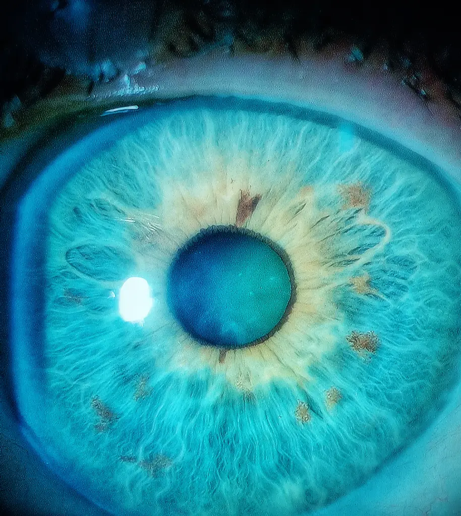 Comparação entre visão normal e visão com catarata